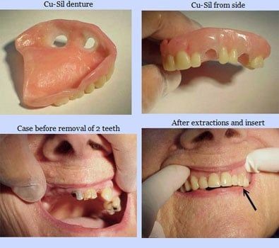 Upper Dentures Without Palate Raleigh NC 27658